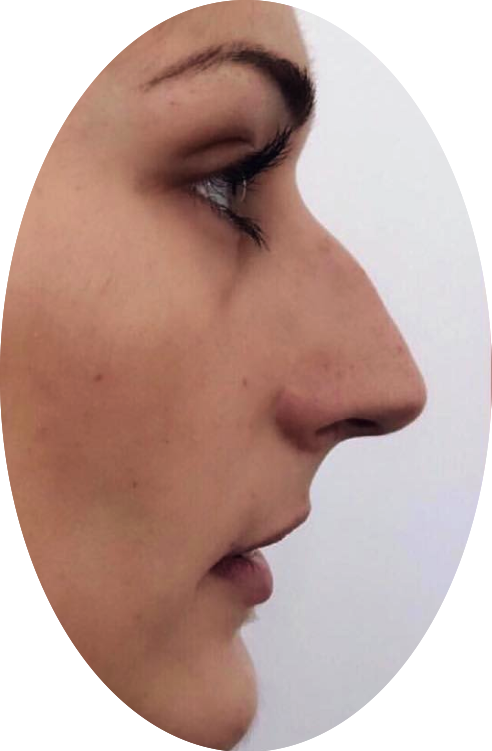 Rhinoplastik Nasenkorrekturen